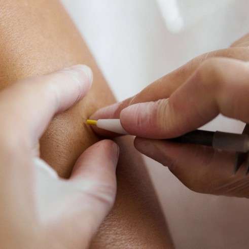 Permanent Hair Removal: Is There a Method for All Hair Colors and Body Areas?